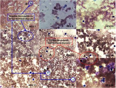 Cases of Impaired Oxidative Burst in HIV-Exposed Uninfected Infants’ Neutrophils—A Pilot Study